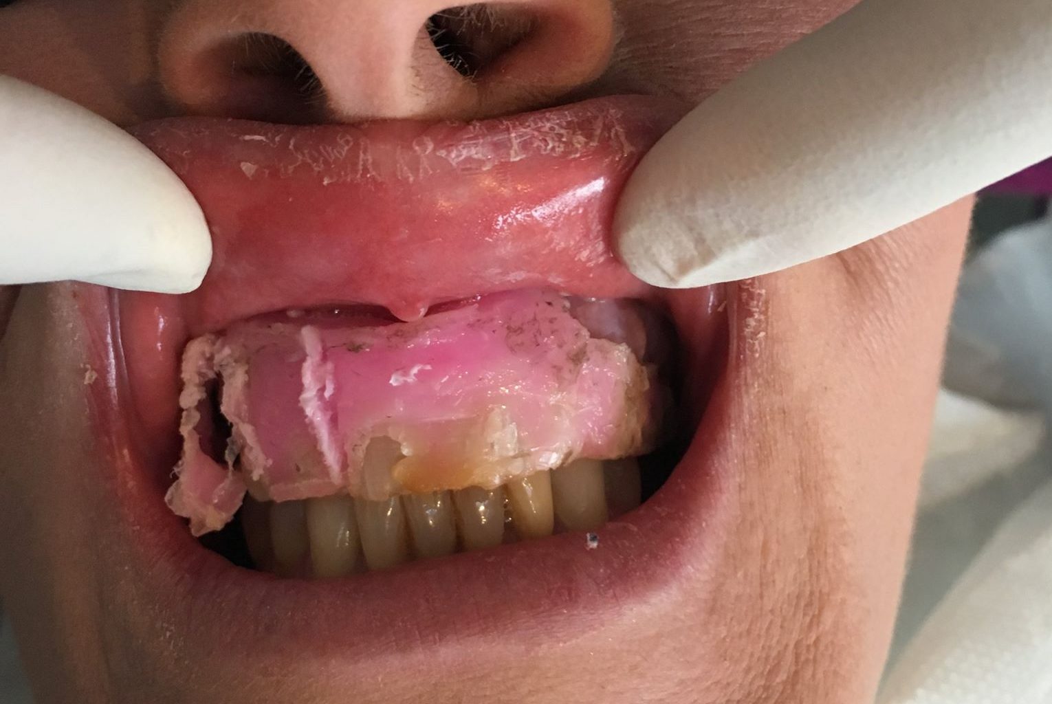 Woman needed two hours of dental work after buying cheap 'veneers'