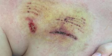 Boy, 9, who grew up around Staffie bitten by “happy” dog at Chippenham park