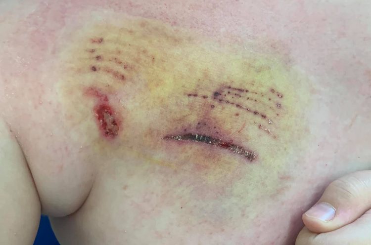 Boy, 9, who grew up around Staffie bitten by “happy” dog at Chippenham park