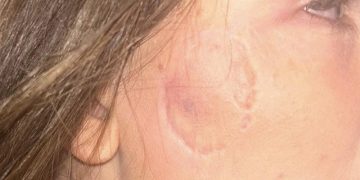 Attacker sinks teeth into woman’s cheek during Swindon incident