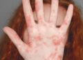 Health chiefs urge MMR uptake as measles cases rise in England