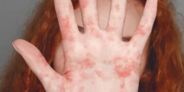 Health chiefs urge MMR uptake as measles cases rise in England