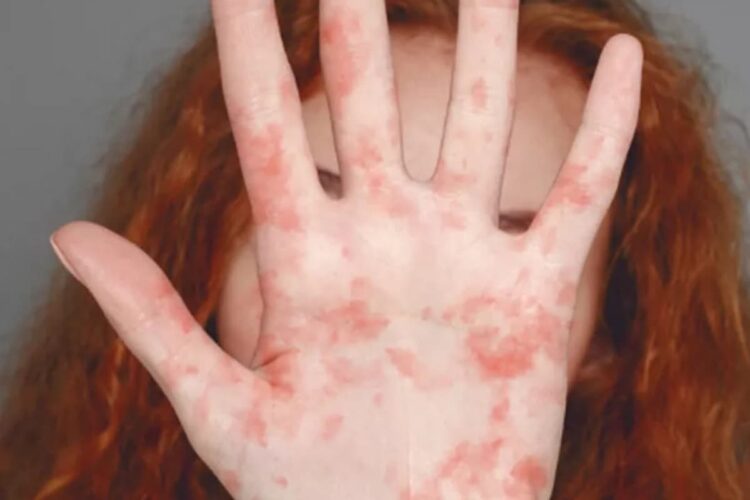 Health chiefs urge MMR uptake as measles cases rise in England